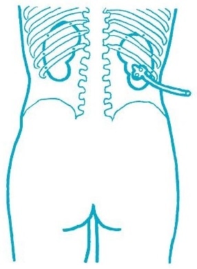 Lokalizacja nefrostomii